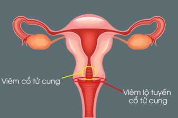 Viêm cổ tử cung và viêm lộ tuyến cổ tử cung có phải là cùng một bệnh?