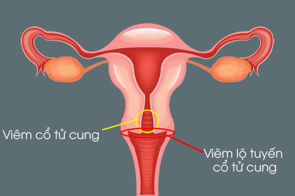 Viêm Cổ Tử Cung và Viêm Lộ Tuyến: Nguyên Nhân, Triệu Chứng và Điều Trị Hiệu Quả